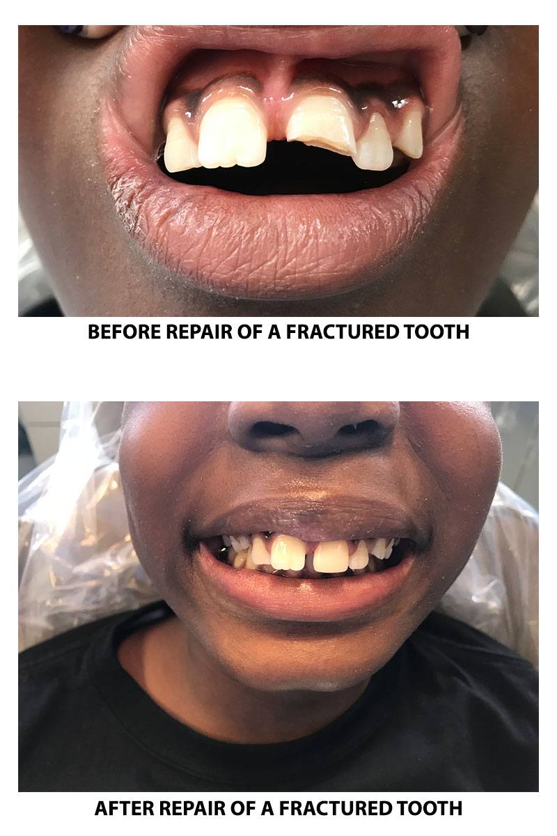 Damaged Teeth?  Fractured Tooth Repair in Fairfield, CT